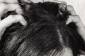 Dandruff
