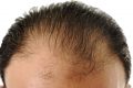 Hair loss