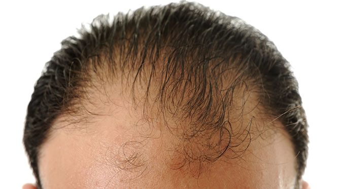 Hair Loss: A Promising New Treatment Works In 10 Days